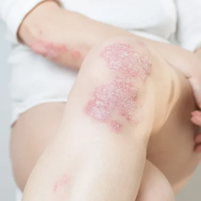 Psoriasis Treatment Denver
