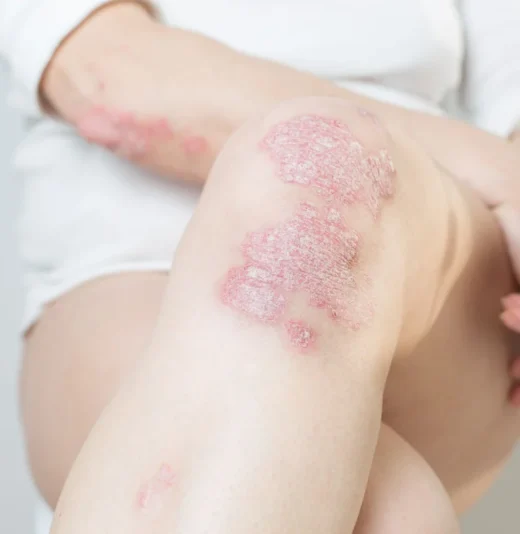 Psoriasis Treatment Denver