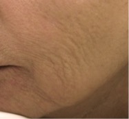 Bumpy Texture on Cheeks