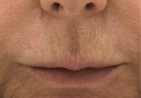 Laser Resurfacing for Lines on Lips