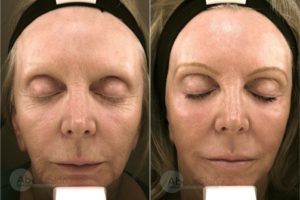 Laser Resurfacing Procedure