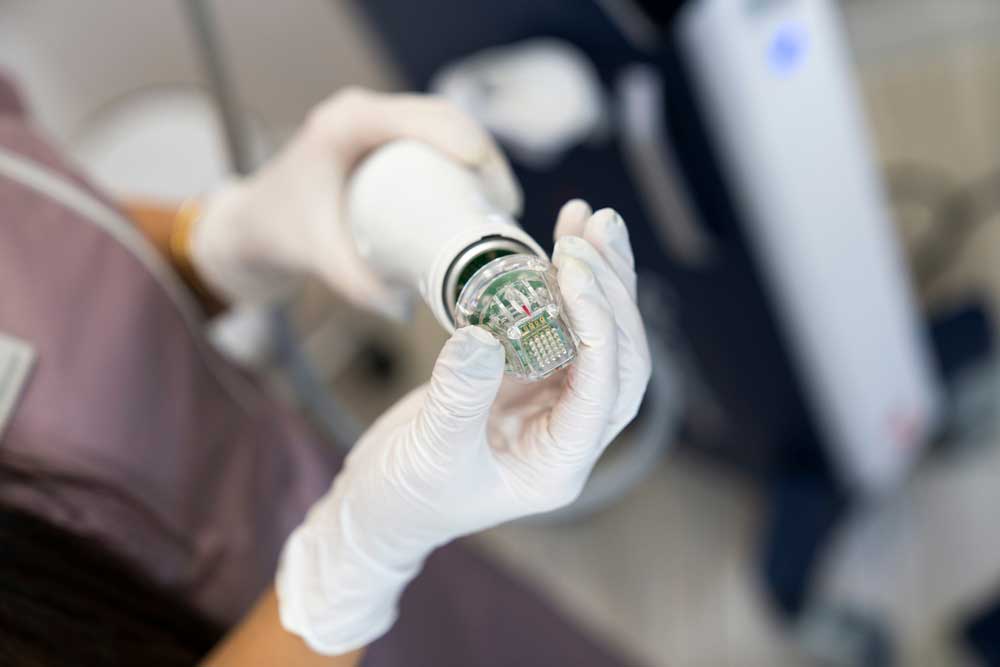 microneedling device for treatments