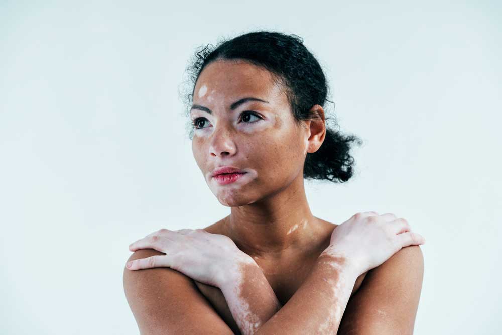 vitiligo skin condition