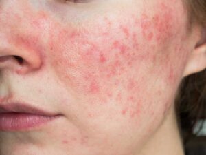 patient with rosacea