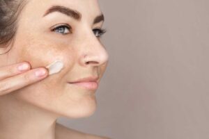 melasma treatment